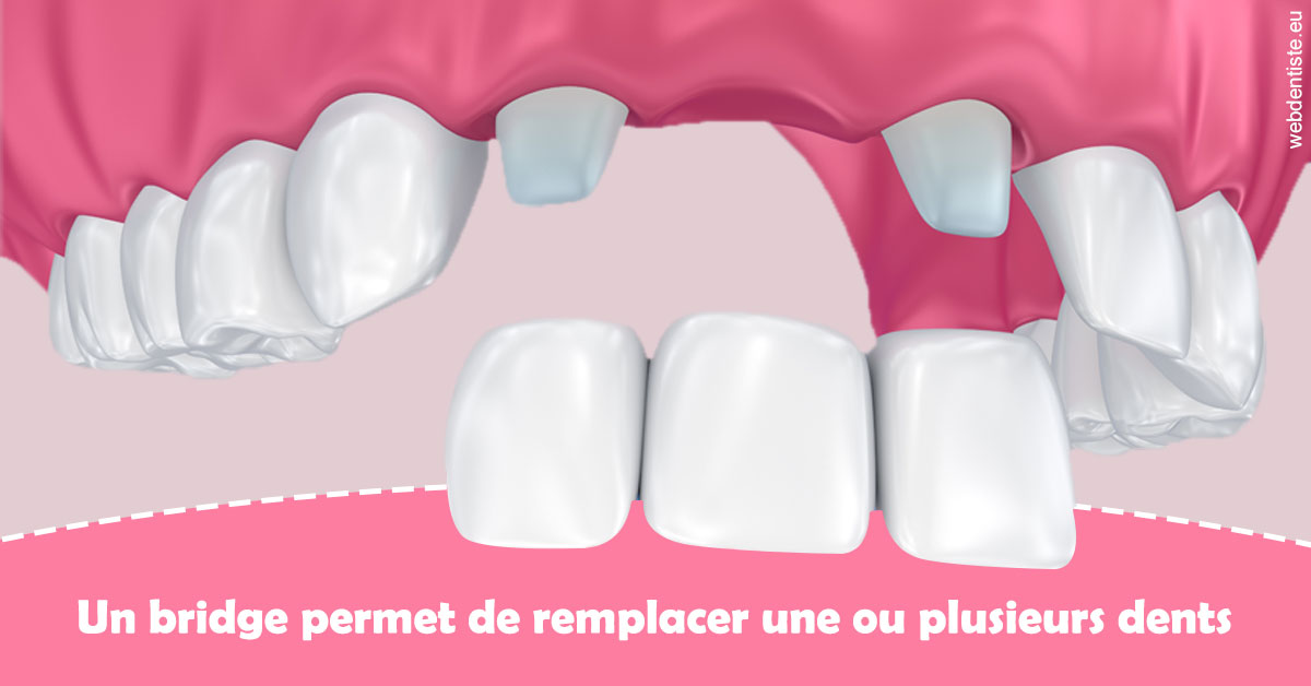 https://selarl-dr-gombauld.chirurgiens-dentistes.fr/Bridge remplacer dents 2