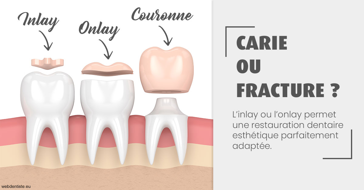 https://selarl-dr-gombauld.chirurgiens-dentistes.fr/T2 2023 - Carie ou fracture 1