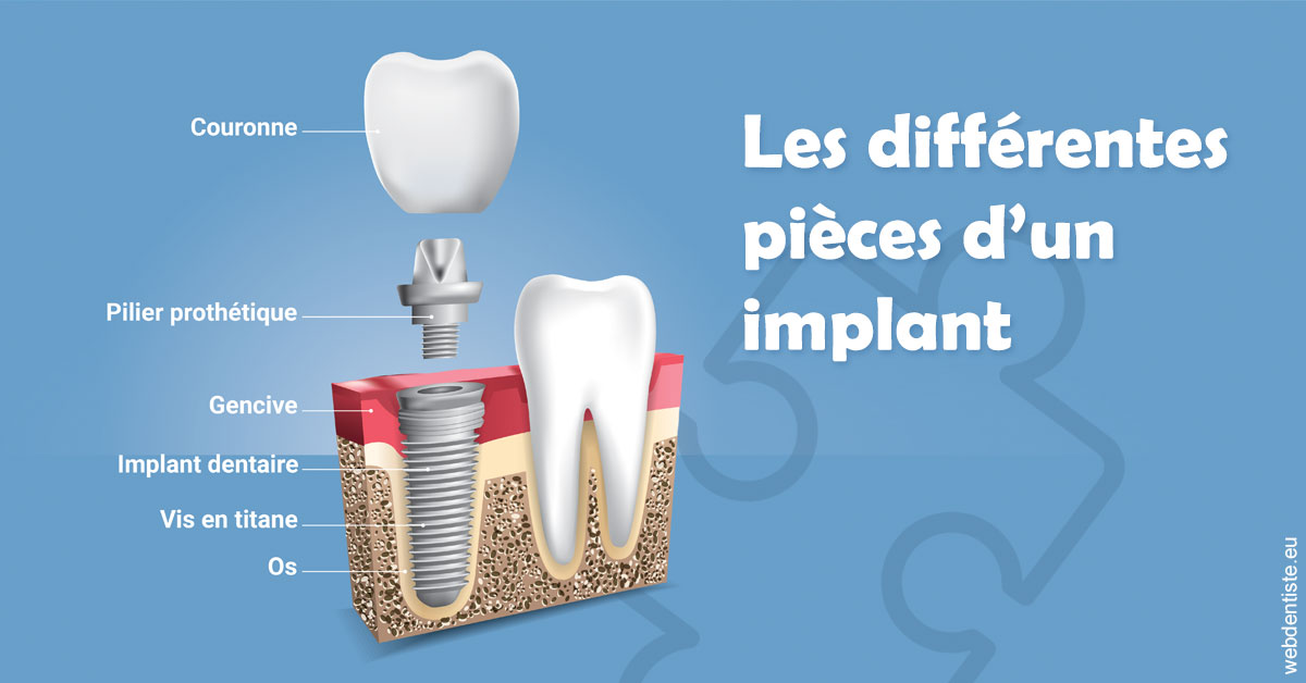 https://selarl-dr-gombauld.chirurgiens-dentistes.fr/Les différentes pièces d’un implant 1